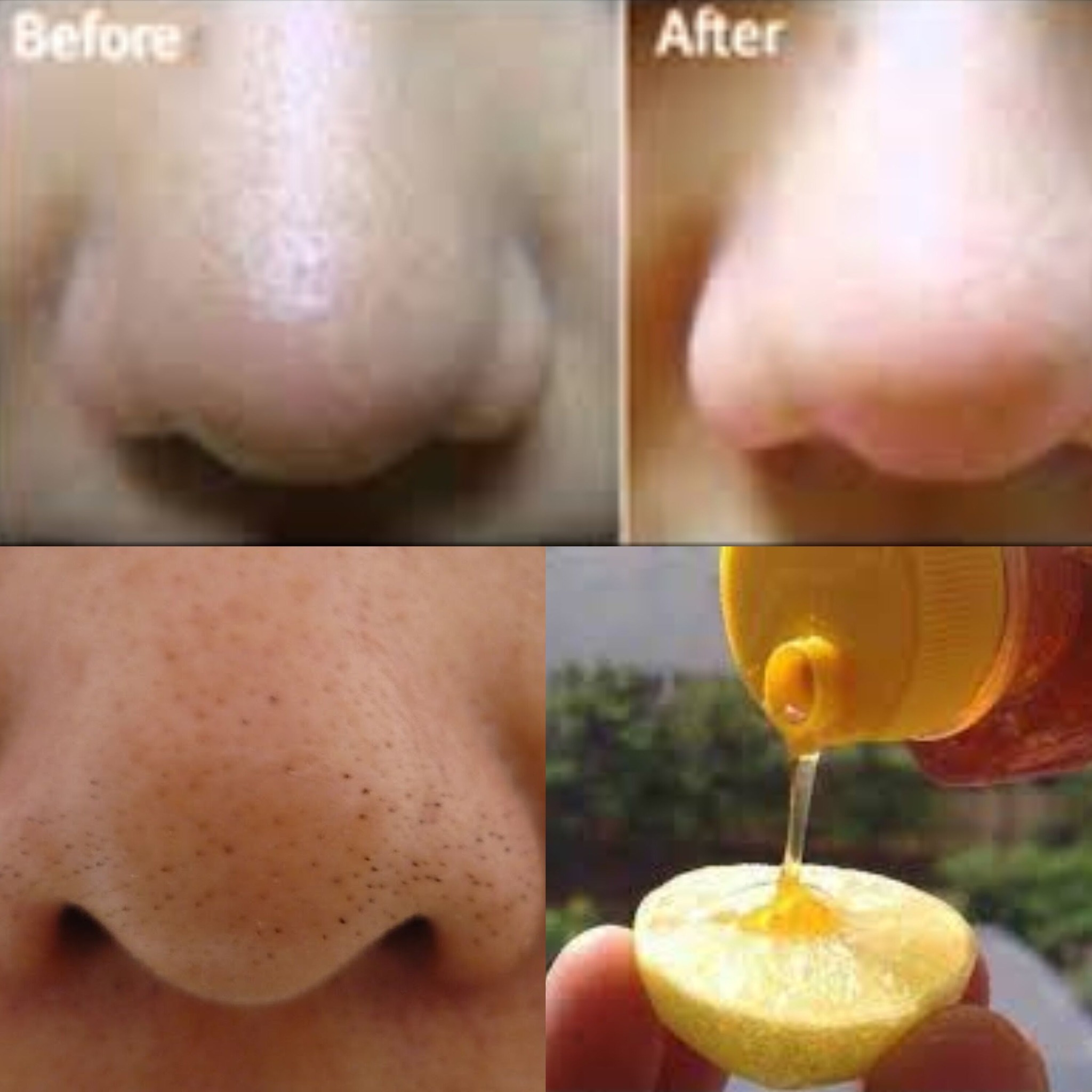 How to Remove Blackheads with a Simple Lemon Recipe