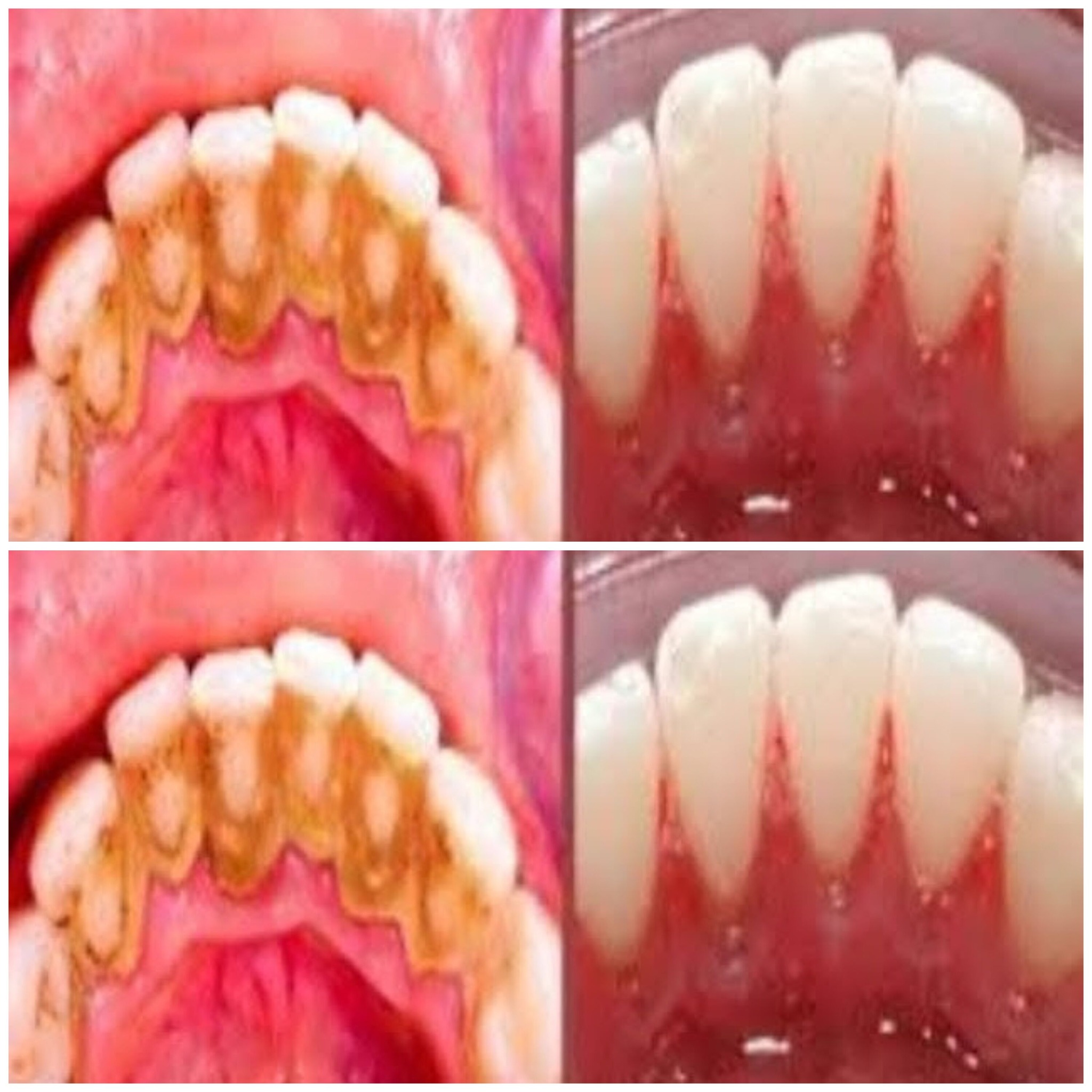 DIY Dental Plaque Removal: Quick and Easy Home Remedy