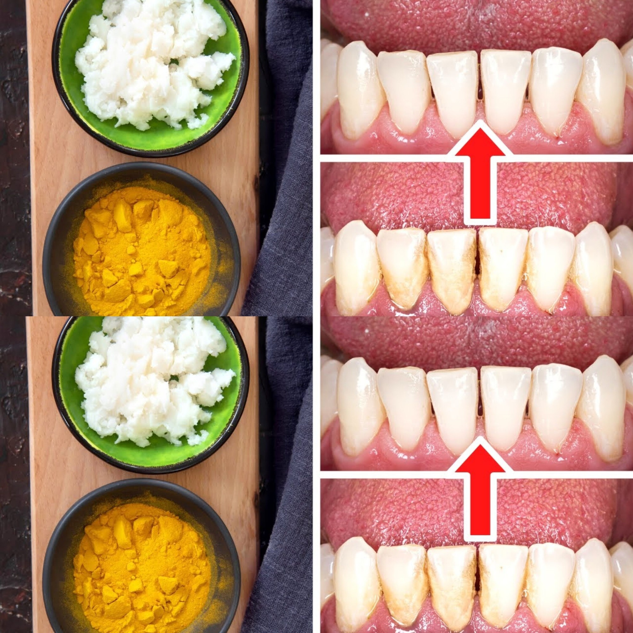 How to Remove Tartar and Plaque from Your Teeth Without a Dentist: Turmeric and Salt