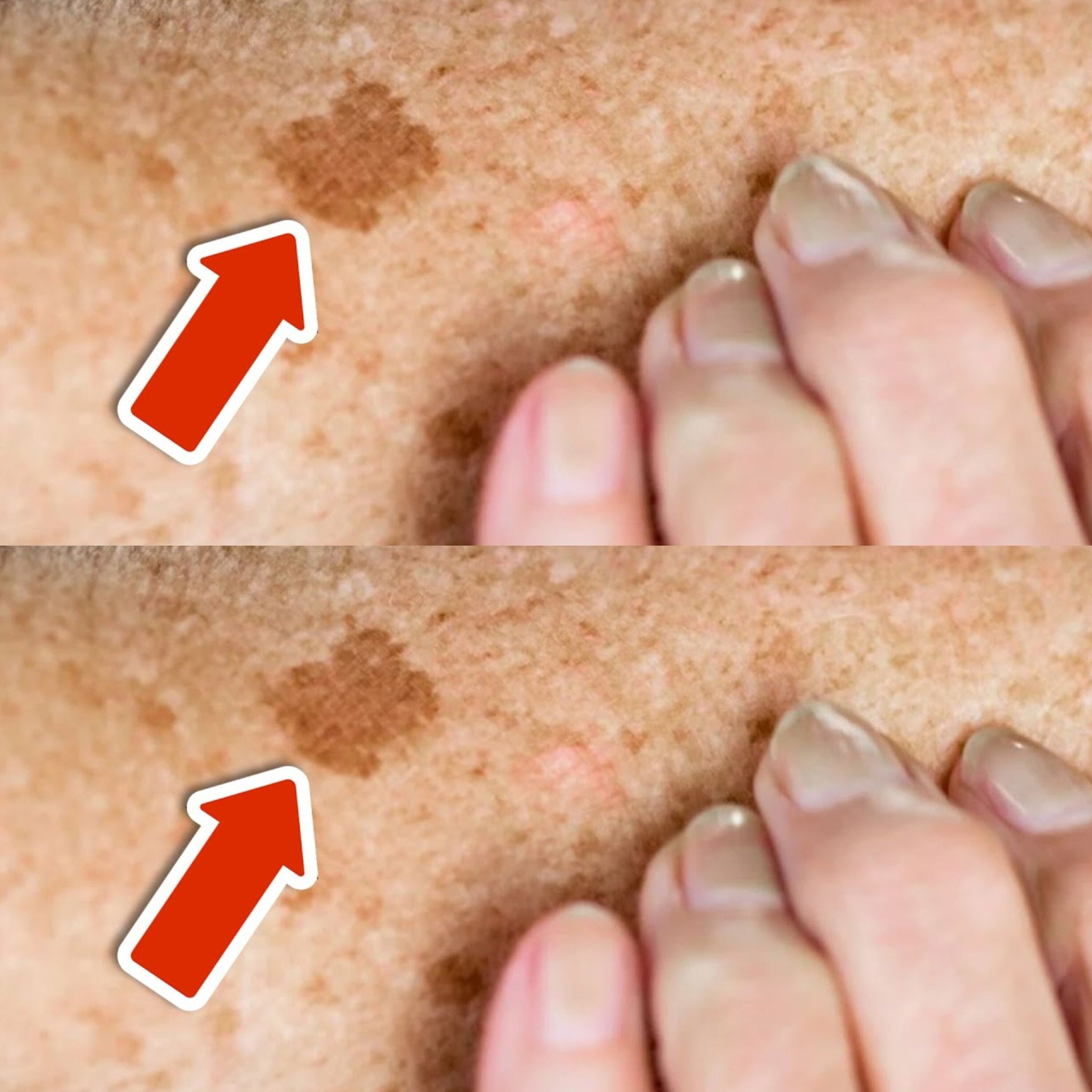 This Vitamin Removes Age Spots Permanently (ALWAYS Works)