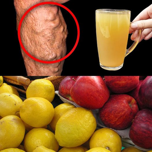 Improve Your Blood Health with Apple and Lemon Juice