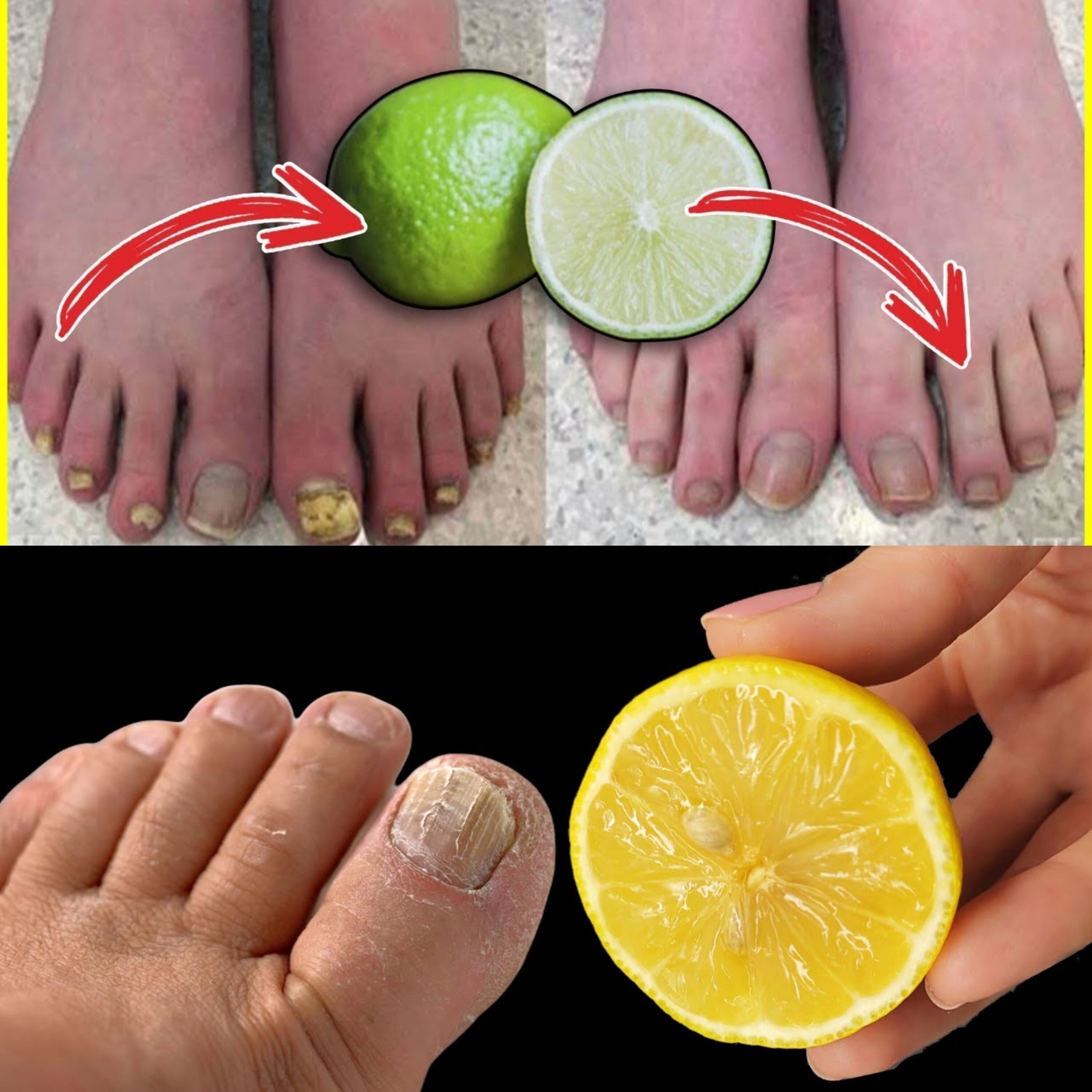 Nail Fungus Removal: 100% Natural Treatment Using Lemon