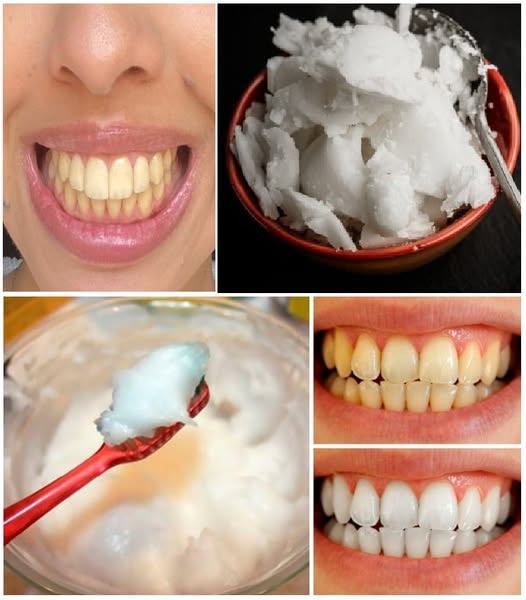 How to Naturally Whiten Your Teeth at Home in Just 3 Minutes Using Baking Soda and Coconut Oil