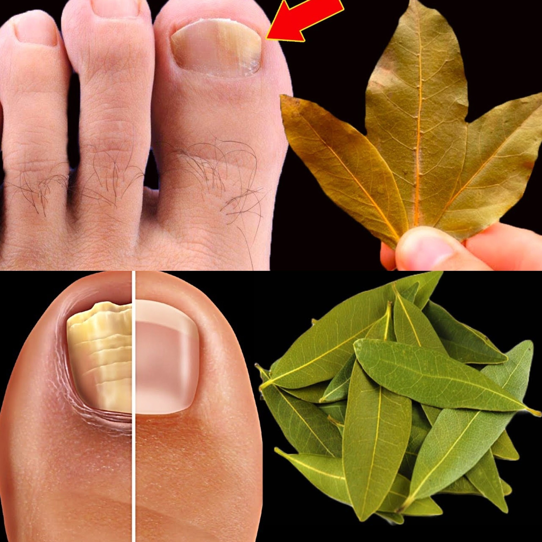 Eliminate Nail Fungus Naturally with Bay Leaves