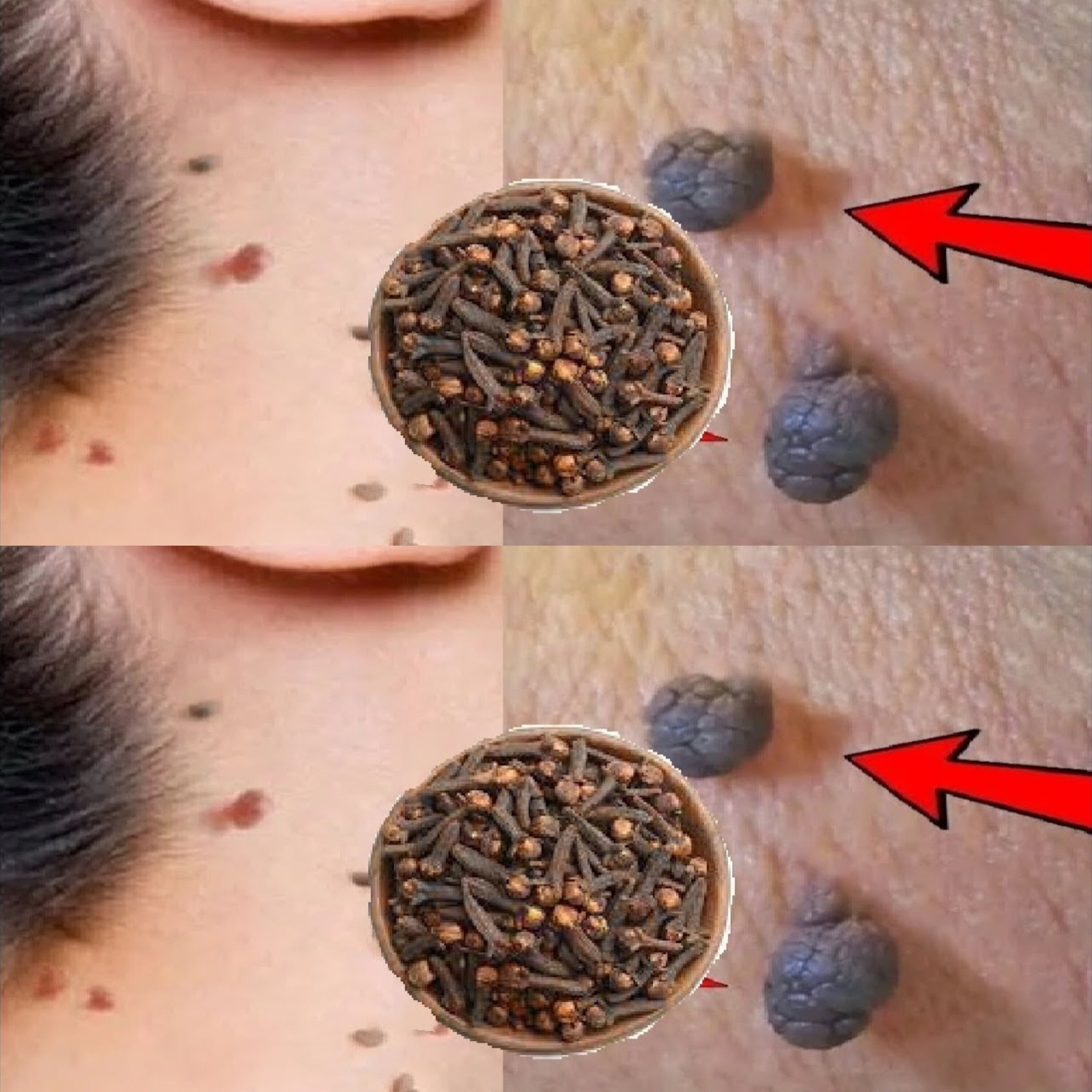 Cloves to Remove Skin Tags and Warts in One Night: A Natural Remedy ?